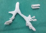 3d-printed-splint-1