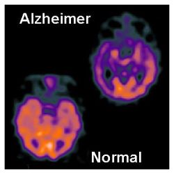 Comparación de cerebros con Alzheimer y sin Alzheimer
