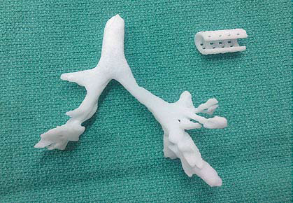 Férula realizada mediante la tecnología de impresión 3D. (Foto:New England Journal of Medicine © 2013)